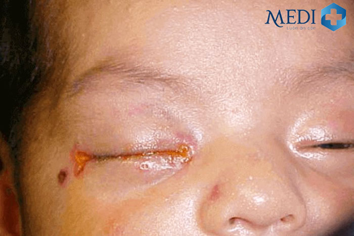 Trẻ sơ sinh bị đau mắt sưng đỏ đóng ghèn và khó mở mắt.