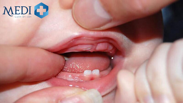 Trẻ mọc răng có thể là nguyên nhẫn dẫn đến đi ngoài phân có mùi chua, nhầy