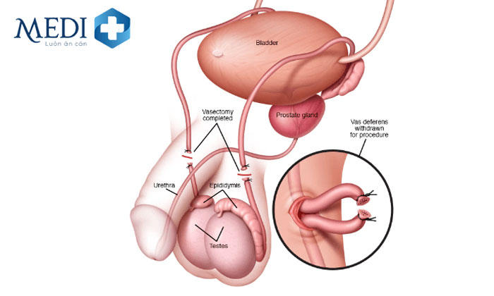 Triệt sản nam giúp ngăn chặn sự sản sinh của tinh trùng.