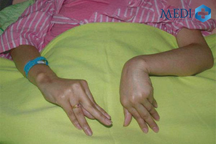 Các triệu chứng điển hình bắt đầu ở các ngón tay, ngón chân gây cảm giác khó chịu.