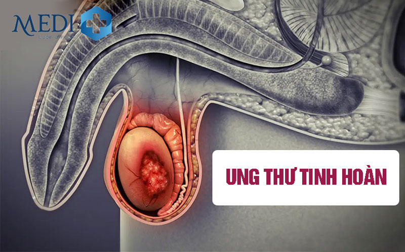 Ung thư tinh hoàn dấu hiệu nhận biết đừng chủ quan