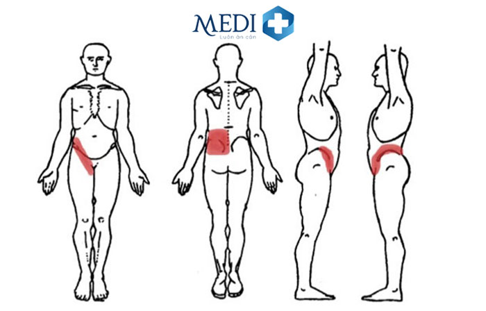 Vị trí đau quặn thận do sỏi