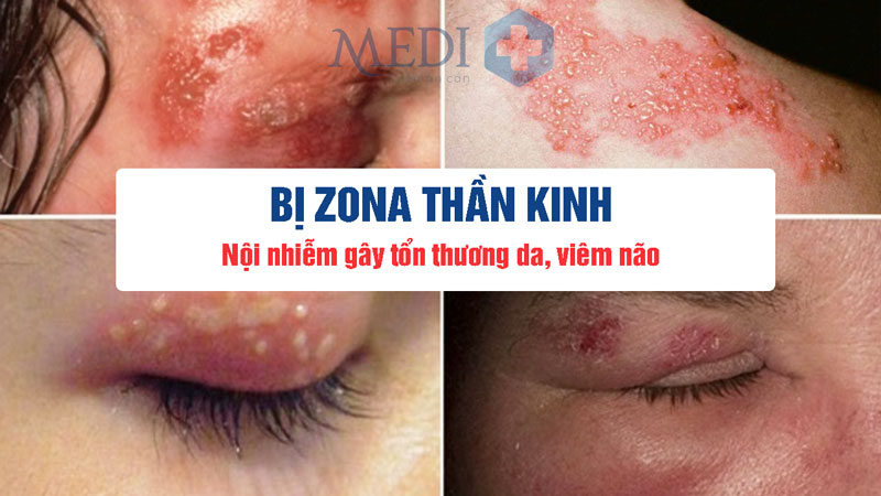 Bệnh zona thần kinh bội nhiễm gây tổn thương da, viêm não