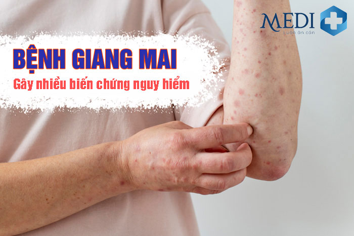 Bệnh giang mai do xoắn khuẩn Treponema Pallidum gây ra nhiều biến chứng