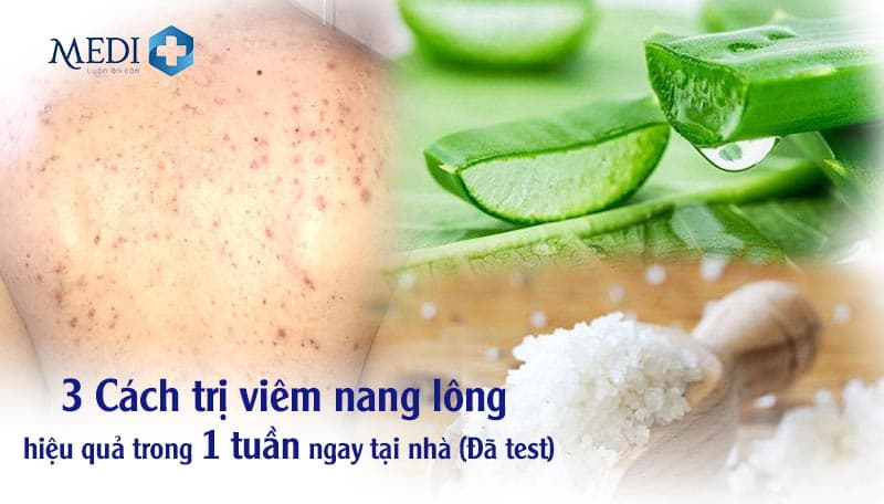 Viêm nang lông hiệu cách điều trị hiệu quả trong 1 tuần ngay tại nhà