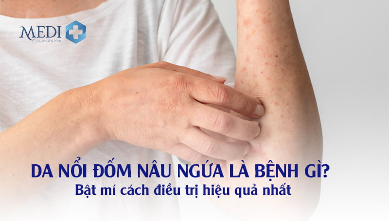 Da nổi đốm nâu ngứa là bệnh gì? Bật mí cách điều trị hiệu quả nhất