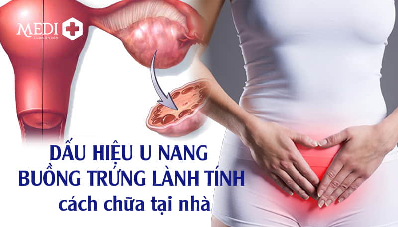 Dấu hiệu u nang buồng trứng lành tính và cách chữa tại nhà