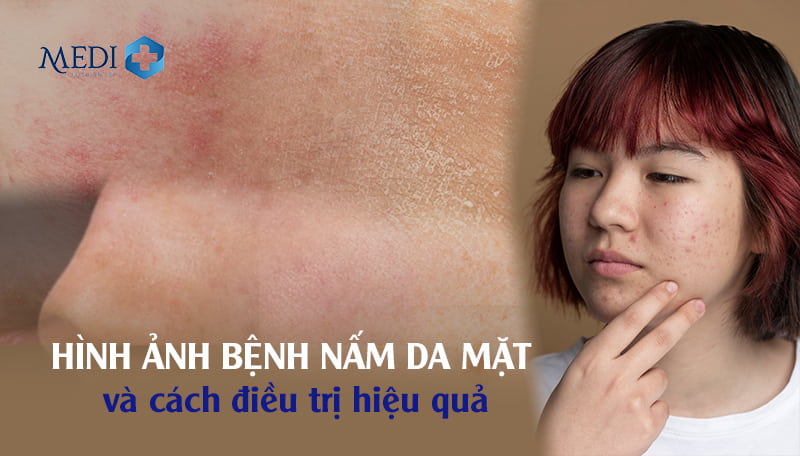 Cận cảnh hình ảnh bệnh nấm da mặt và cách điều trị tại nhà cực hiệu quả