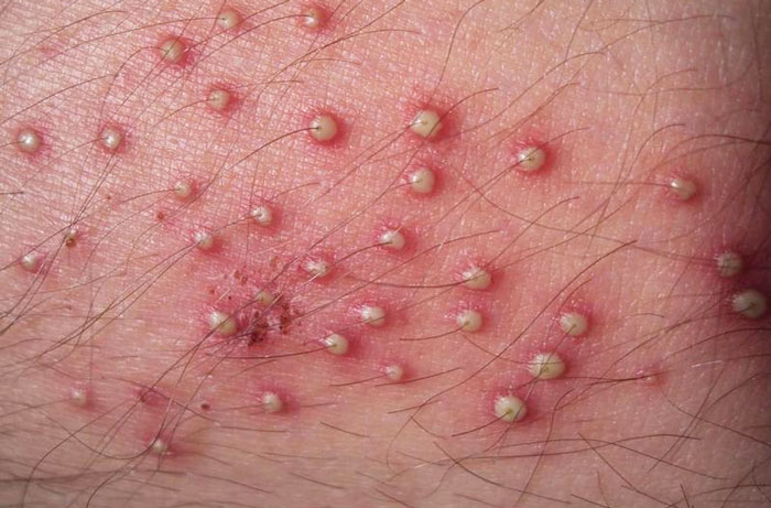 Viêm nang lông với các nốt đỏ hoặc đen sẫm quang vùng nang lông.
