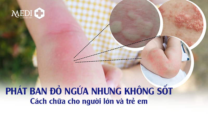 Phát ban đỏ ngứa nhưng không sốt là bệnh gì? Có nguy hiểm không?