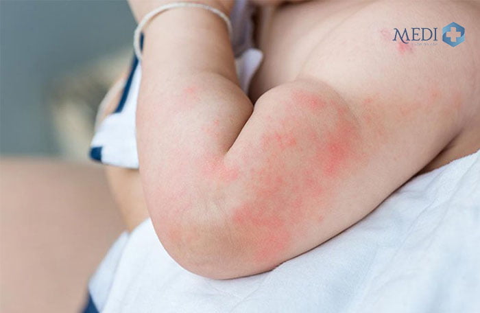 Trẻ bị phát ban da nổi mẩn đỏ ngứa nhưng không có hiện tượng sốt