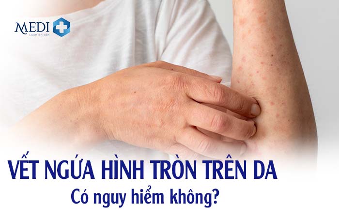 Vết ngứa hình tròn trên da là bị bệnh gì? Có nguy hiểm không?