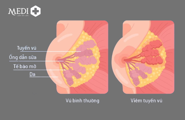 Viêm tuyến vú do tắc tuyến sữa gây sưng đỏ và đau vùng ngực