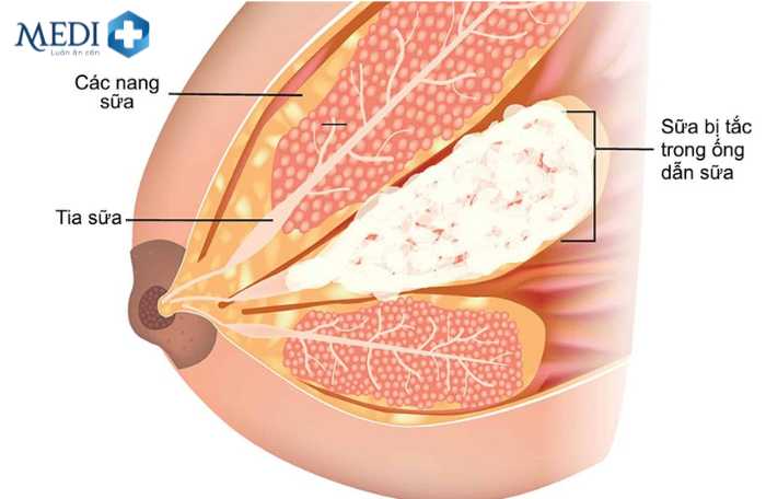 Tắc ống dẫn sữa là nguyên nhân gây viêm tuyến vú