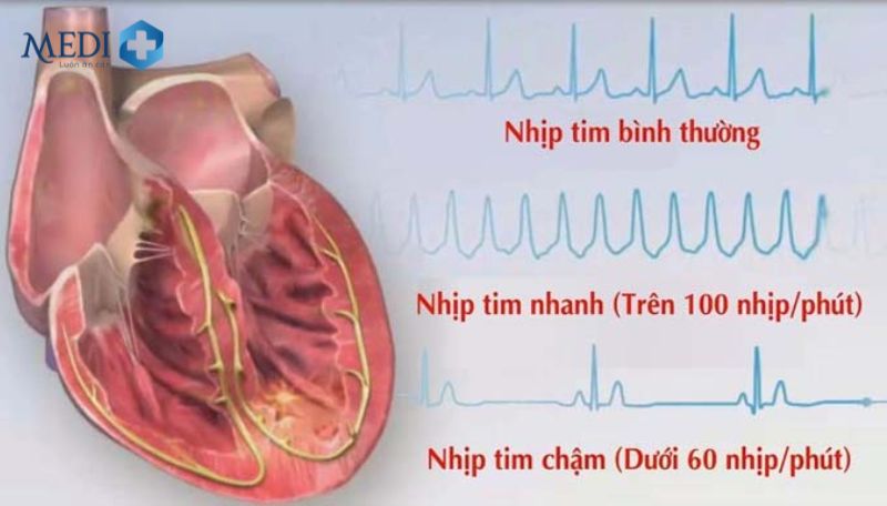 Rối loạn nhịp tim là gì?