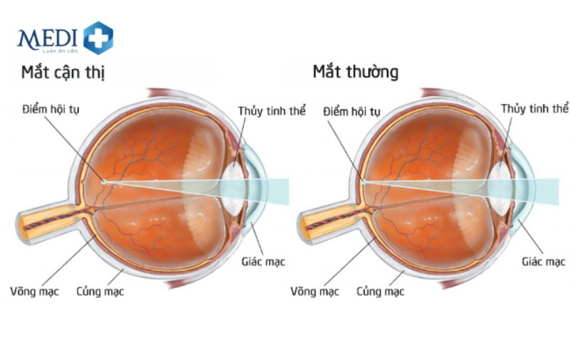 Có nhiều nguyên nhân gây ra cận thị