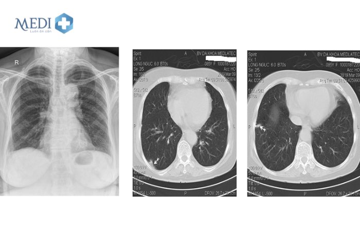 Chụp cắt lớp vi tính (CT) lồng ngực liều thấp