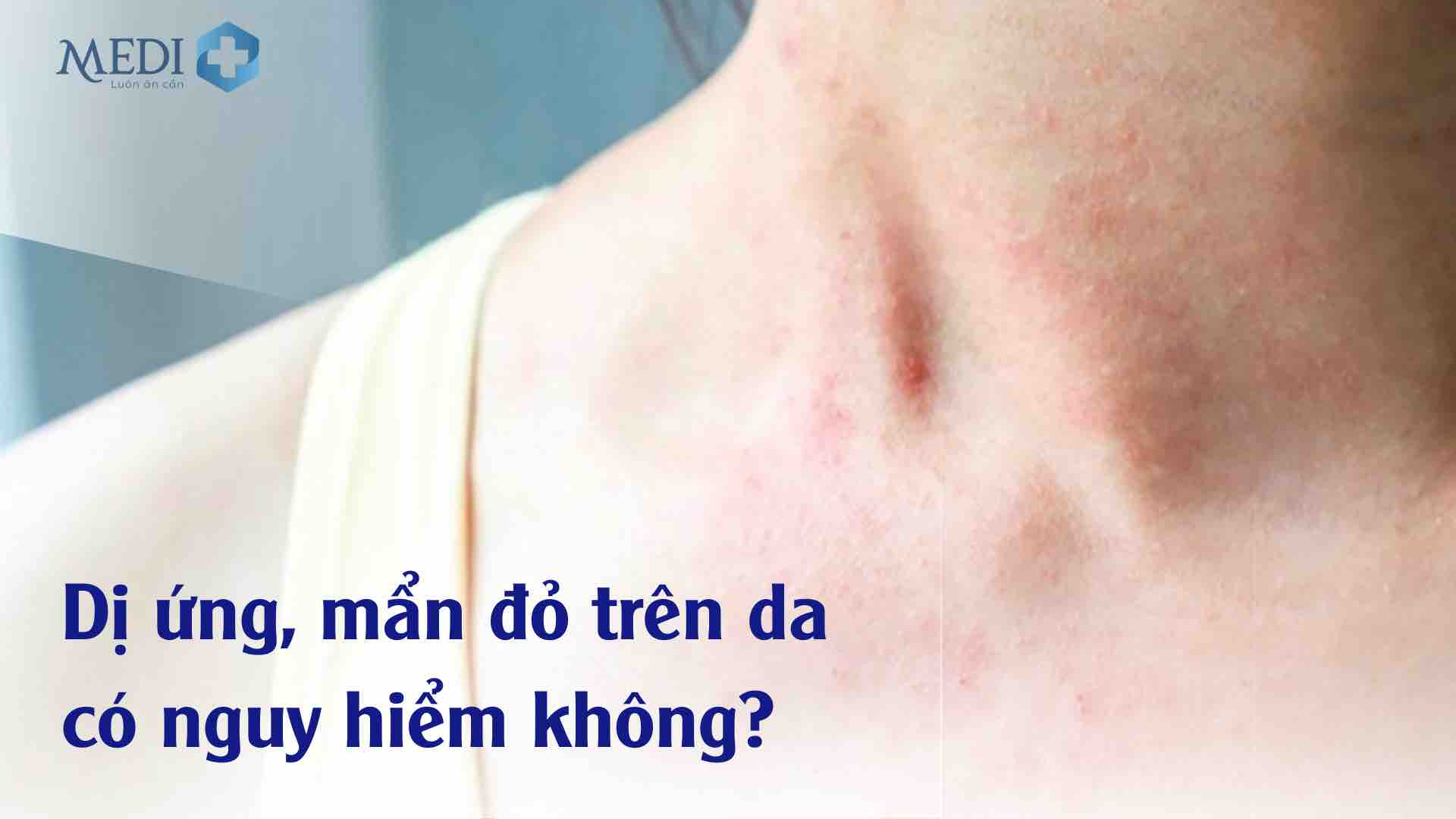 Làm gì khi bị dị ứng da nổi mẩn đỏ? Nguyên nhân và cách chữa trị