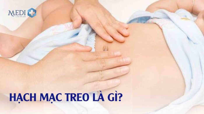 Hạch mạc treo, viêm hạch mạc treo là gì?