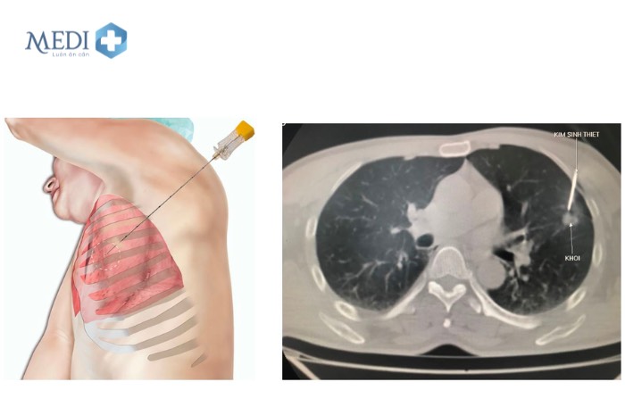 Sinh thiết phổi xuyên thành ngực