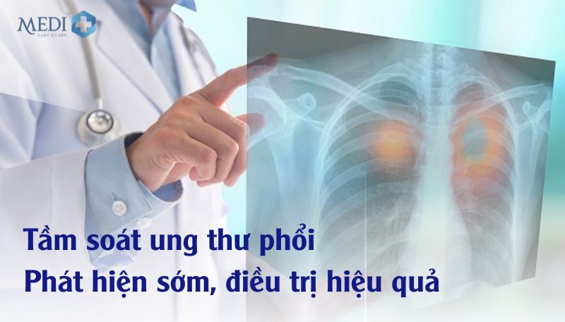 Tầm soát ung thư phổi phát hiện bệnh sớm, điều trị hiệu quả