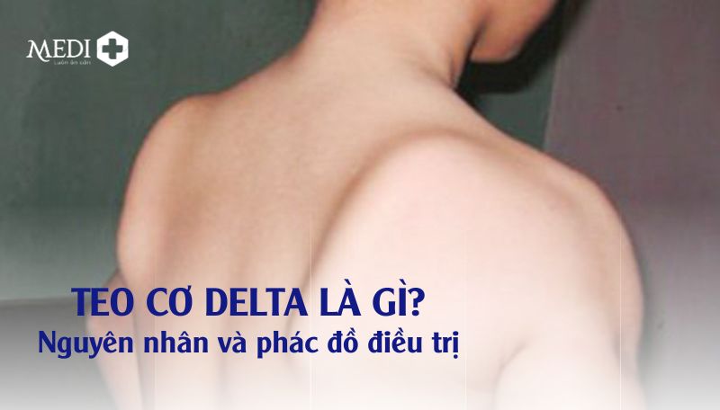 Teo cơ delta là gì? Nguyên nhân và phác đồ điều trị tốt nhất