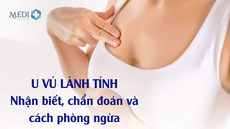 U vú lành tính có biến chứng ung thư và có nguy hiểm không?