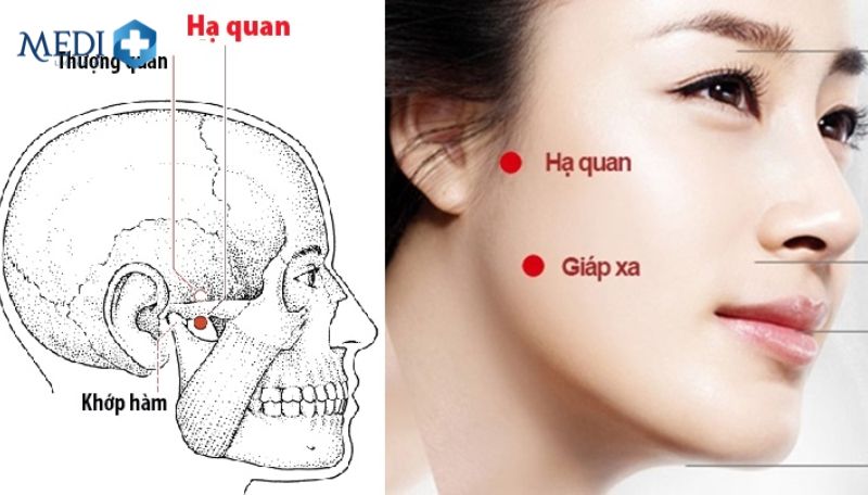 Huyệt Hạ Quan nằm ở phần lõm trước tai và xương dưới gò má
