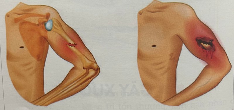 Hình ảnh minh họa tình trạng gãy xương