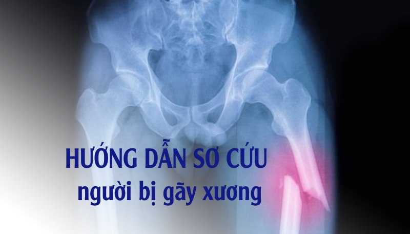 Hướng dẫn sơ cứu gãy xương đúng kỹ thuật