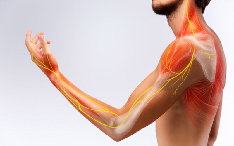 Hội chứng cổ vai cánh tay: Nguyên nhân, triệu chứng và phương pháp điều trị