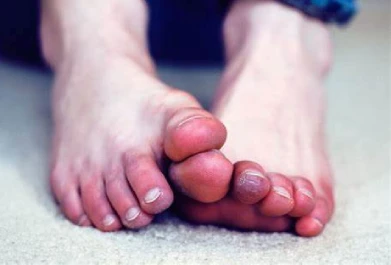 Những biến chứng nguy hiểm khi ngón chân cái bị đau buốt