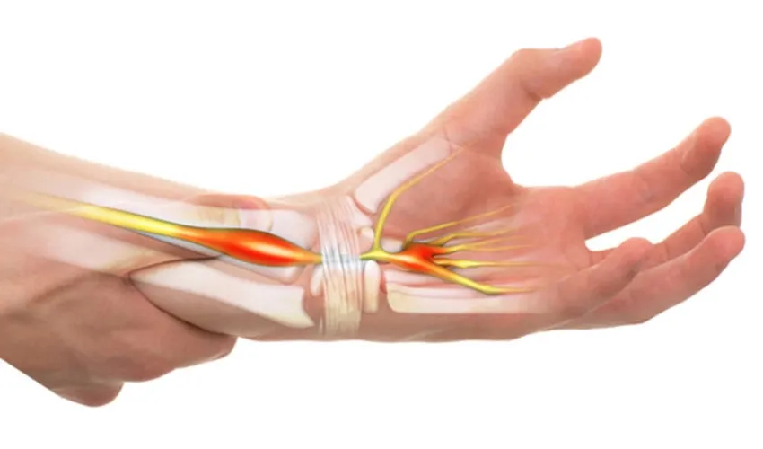 Hội chứng ống cổ tay là nguyên nhân bị đau cổ tay nhưng không xưng