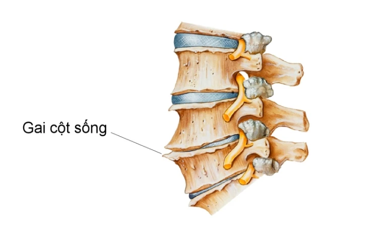 Các triệu chứng của gai cột sống