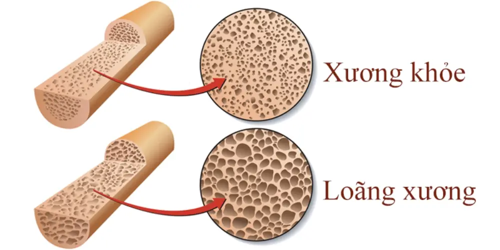 Tổng hợp nguyên nhân loãng xương ở người trẻ