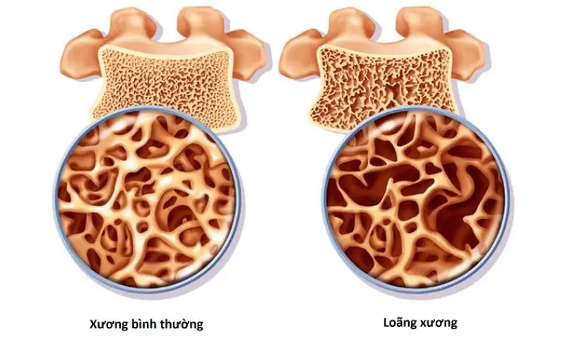 Bệnh loãng xương khiến xương yếu và dễ gãy 