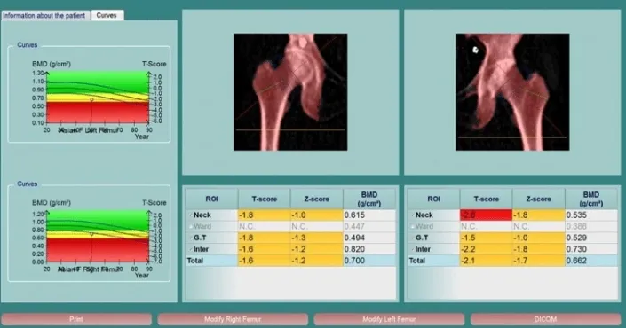 Chỉ số T-score để đánh giá mức độ loãng xương