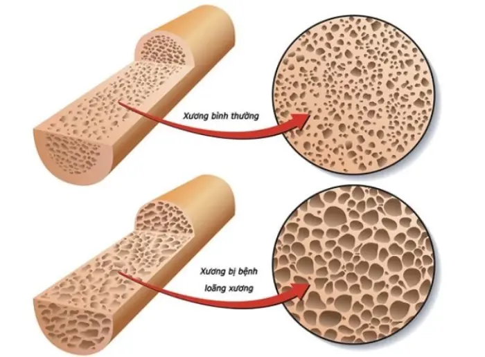 Tìm hiểu về bệnh loãng xương