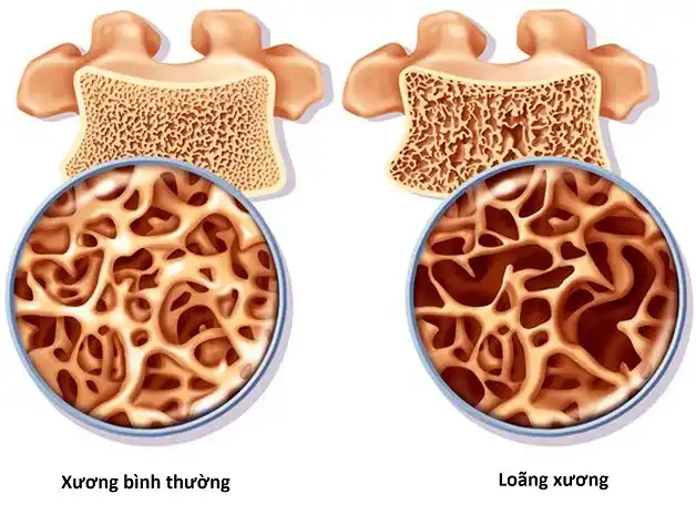 Tổng hợp các nguyên nhân gây loãng xương ở trẻ em