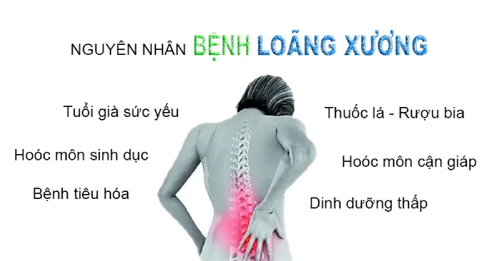 Nguyên nhân khiến bạn bị loãng xương?