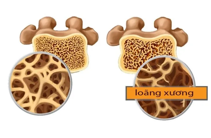 Nguyên nhân của bệnh loãng xương: Những điều bạn chưa biết