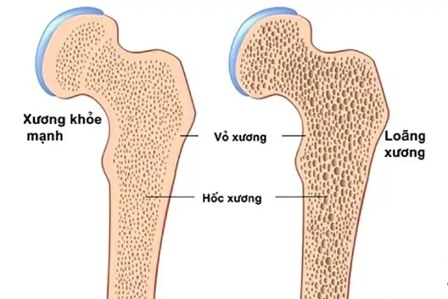 Các trường hợp nên đi đo mật độ xương