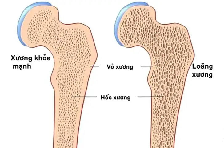 Tìm hiểu về bệnh loãng xương