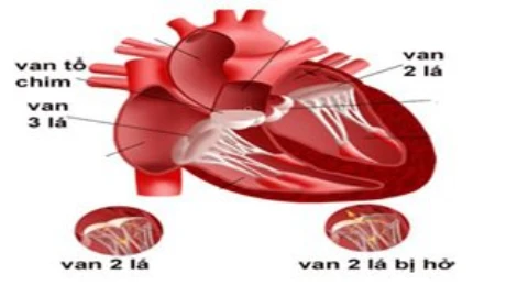 Tìm hiểu về bệnh hở van tim 2 lá