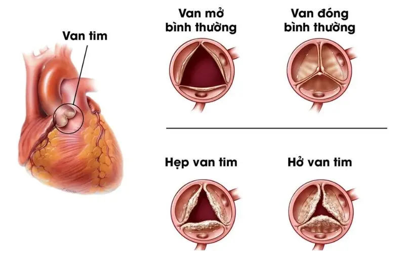 Tìm hiểu các dấu hiệu hở van tim mạch