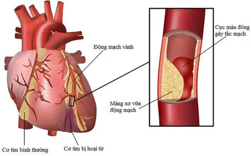 Hậu quả có thể dẫn đến khi không phát hiện sớm các vấn đề tim mạch