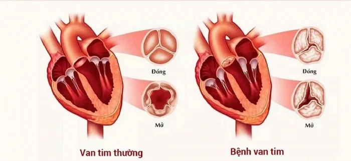 Tìm hiểu về bệnh hở van tim 2 lá