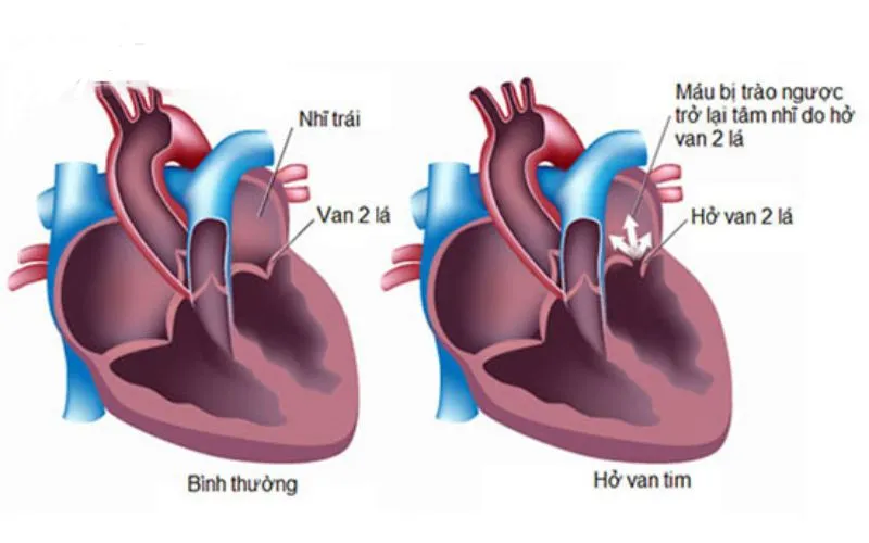 Hở Van Tim 2 Lá 2/4 Có Nguy Hiểm Không? Lời Khuyên Từ Chuyên Gia