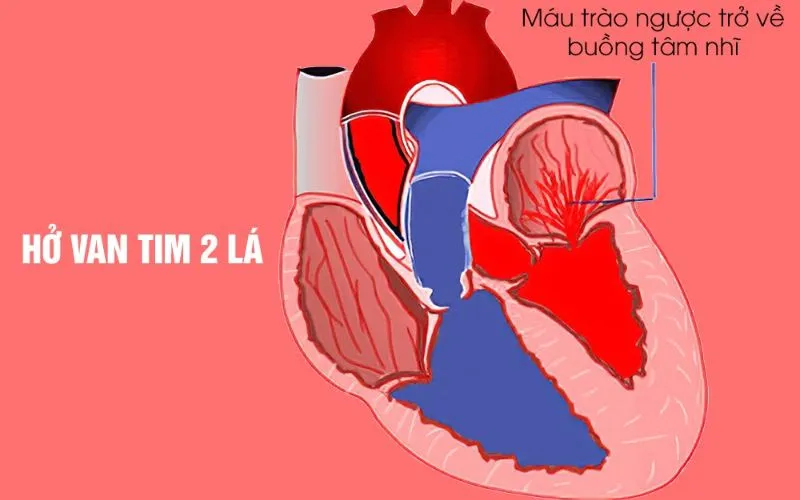 Hở van tim 2 lá là tình trạng gì?