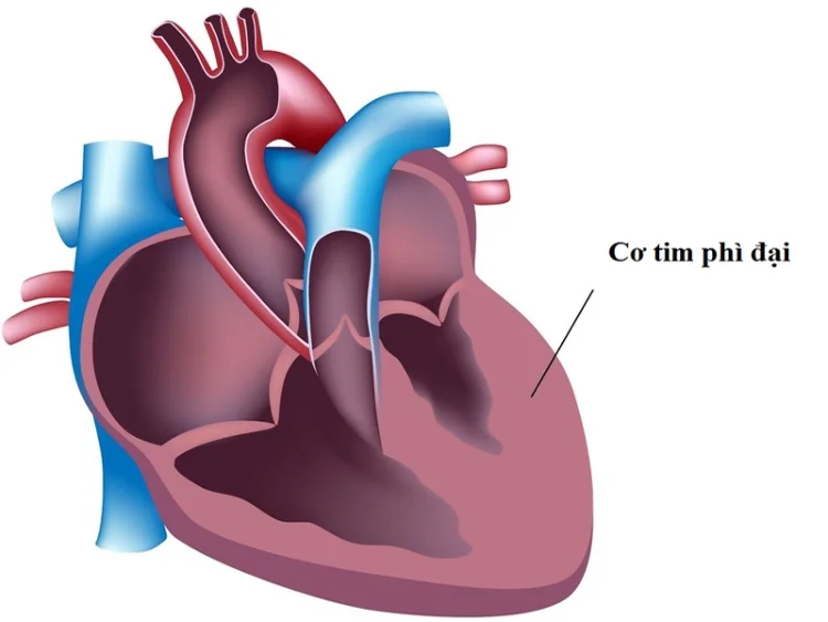 Hở van tim 2 lá 1/4 có nguy hiểm không?